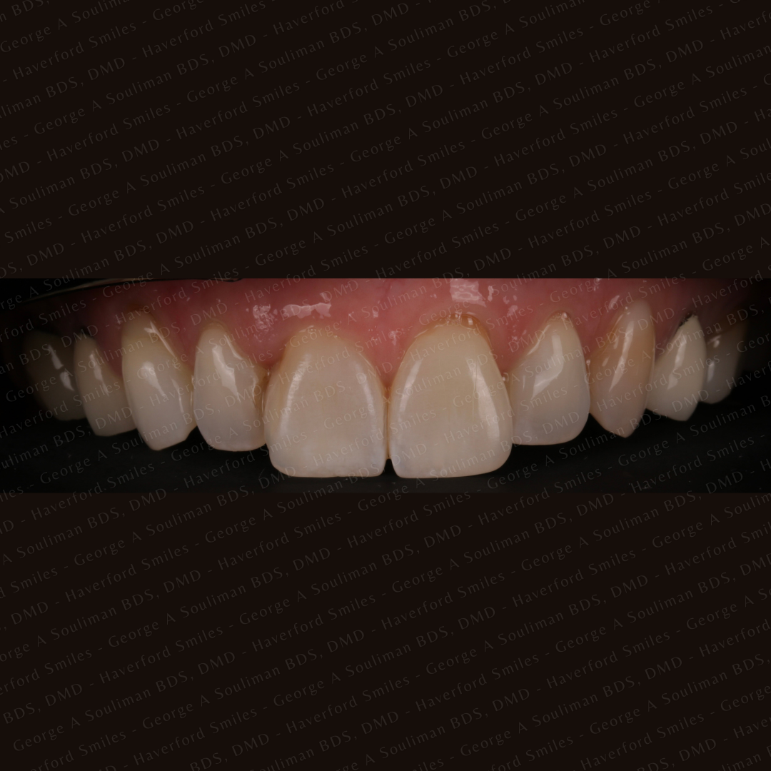 Full mouth rehab Ceramic Veneers, Implants & Ceramic crowns top arch before