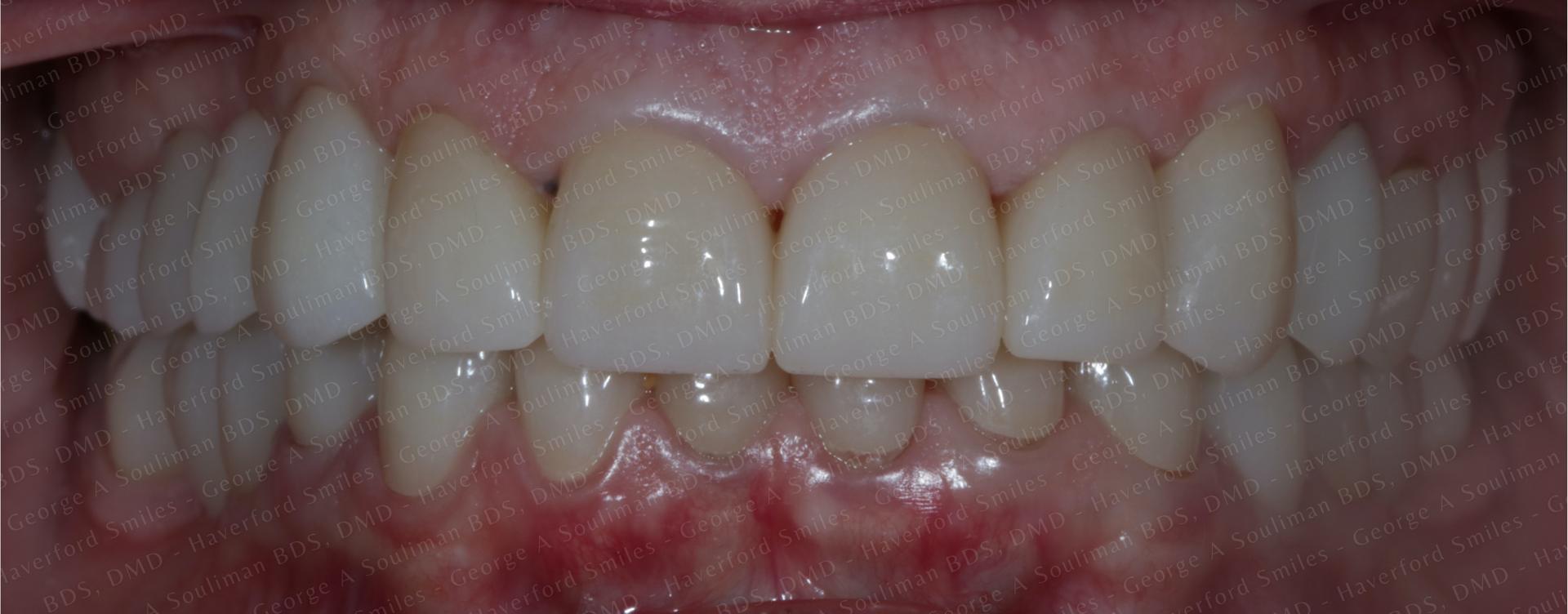 Full mouth rehab with Ceramic Crowns & Ceramic Bridges after
