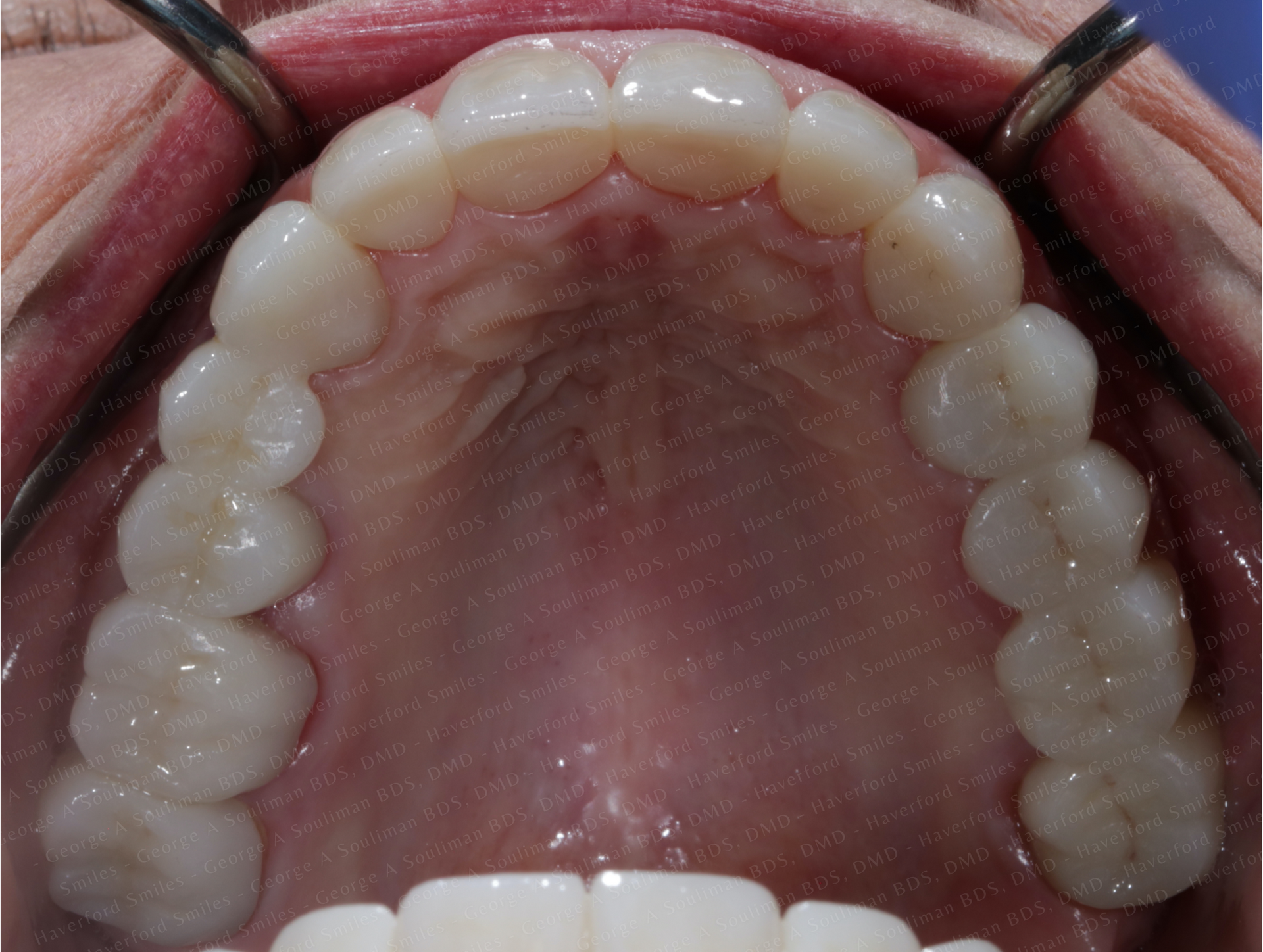 Full mouth rehab with Ceramic Crowns & Ceramic Bridges after