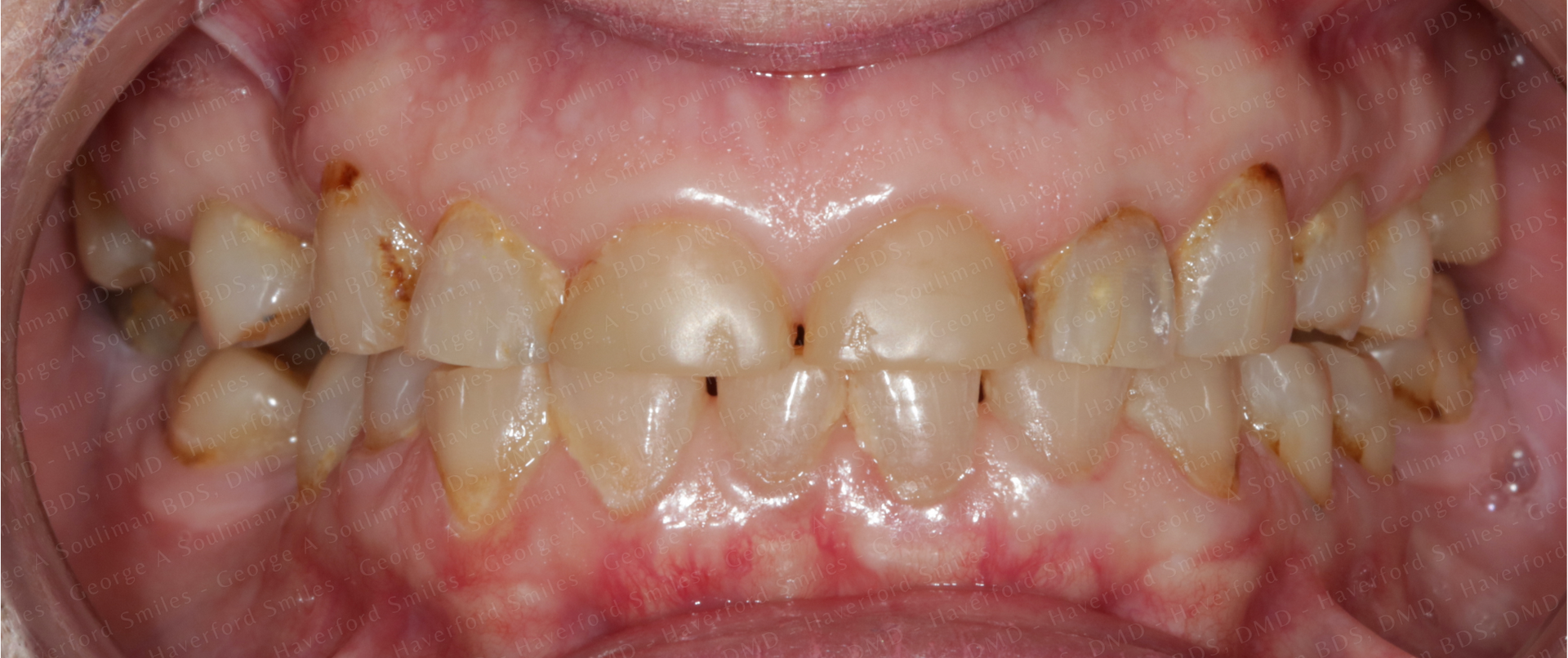 Full mouth rehab with Ceramic Crowns & Ceramic Bridges before