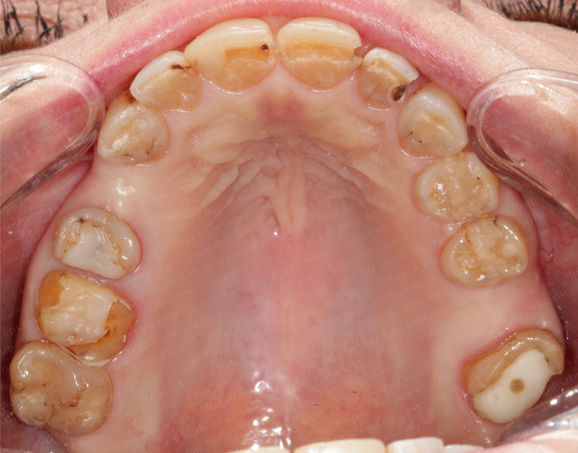 Full mouth rehab with Ceramic Crowns & Ceramic Bridges before