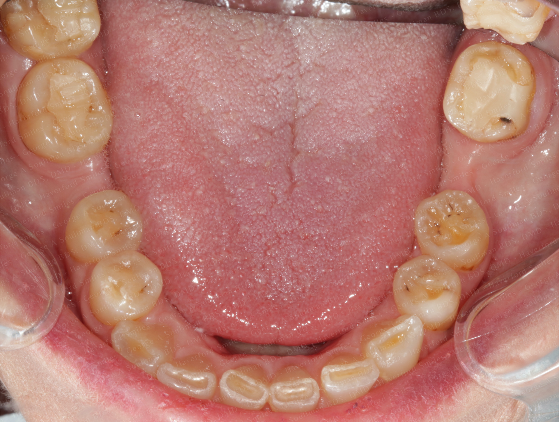 Full mouth rehab with Ceramic Crowns & Ceramic Bridges before