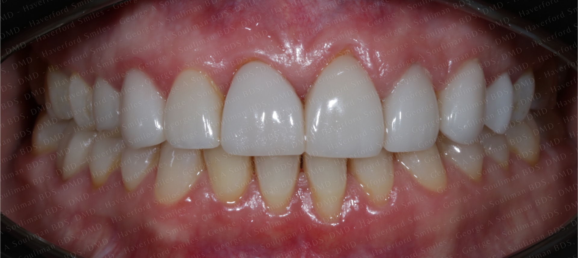 Full mouth rehab Ceramic Veneers & Ceramic Crowns before