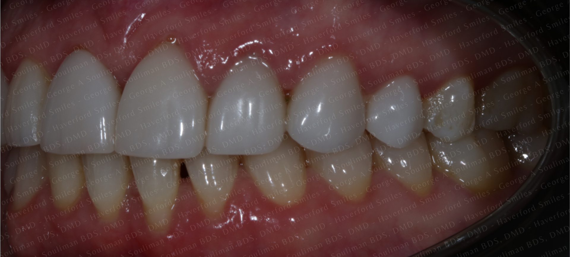 Full mouth rehab Ceramic Veneers & Ceramic Crowns before
