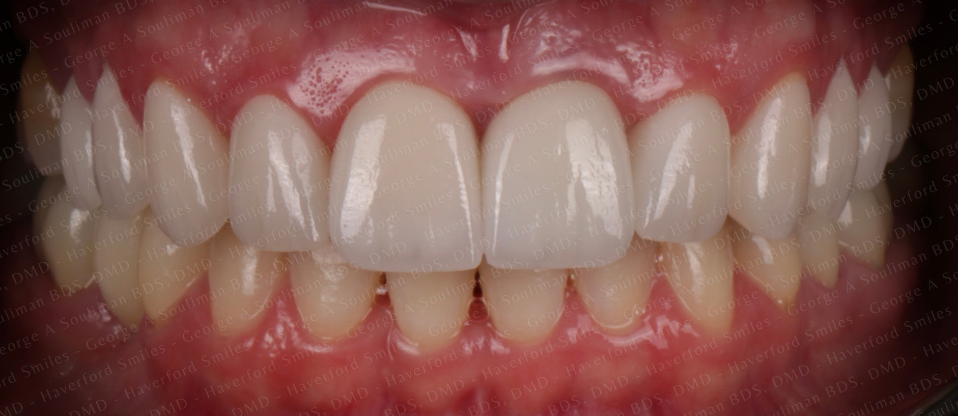 Full mouth rehab Ceramic Veneers, Ceramic Crowns & Ceramic Bridge after