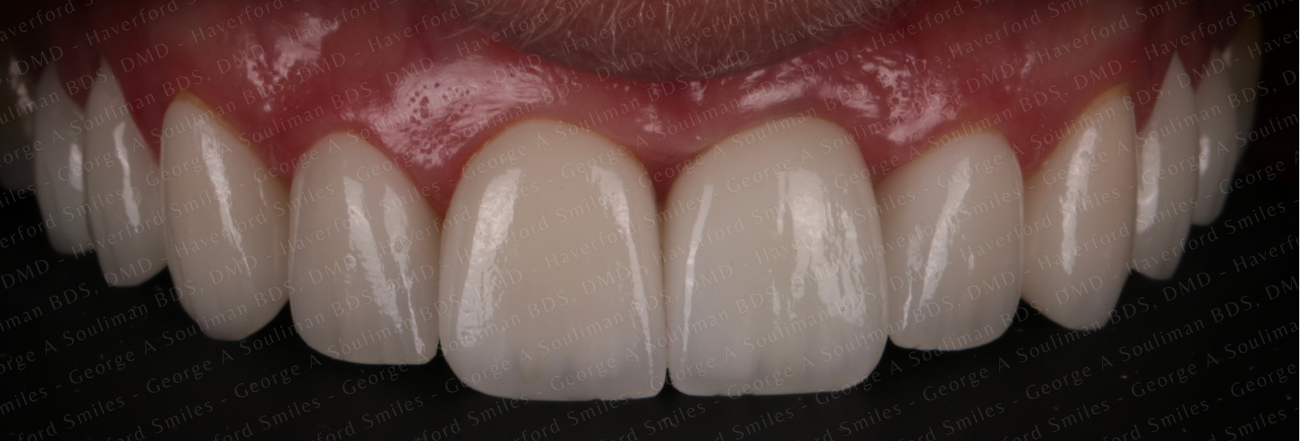 Full mouth rehab Ceramic Veneers, Ceramic Crowns & Ceramic Bridge after