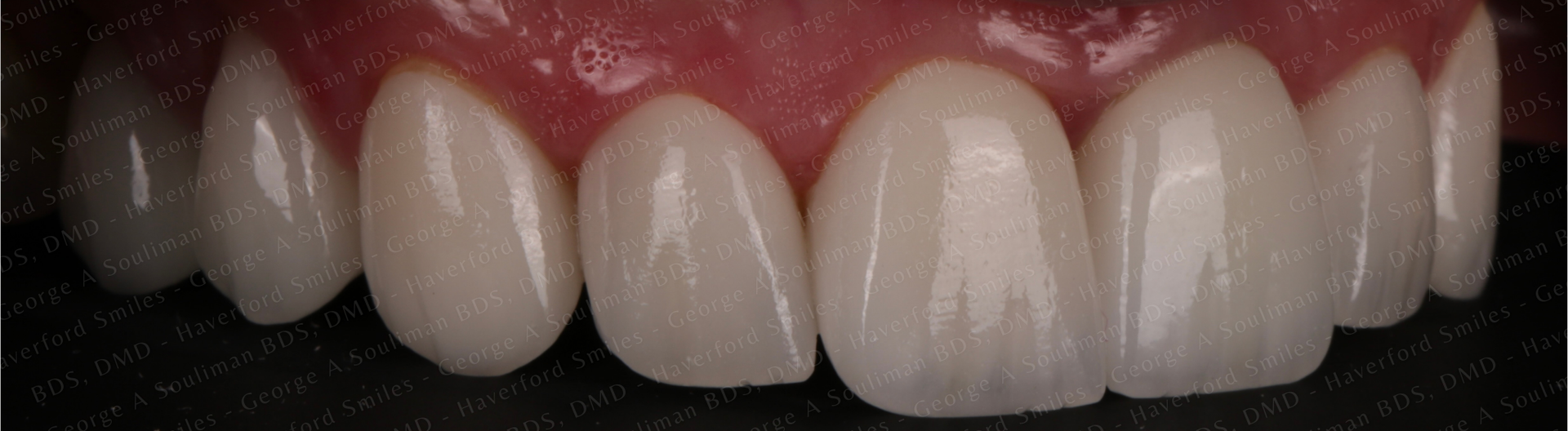 Full mouth rehab Ceramic Veneers, Ceramic Crowns & Ceramic Bridge after
