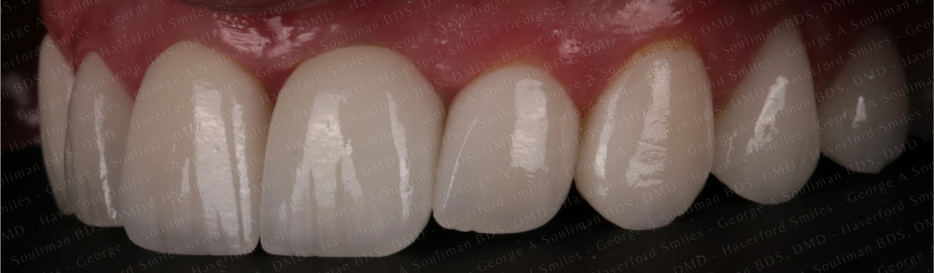 Full mouth rehab Ceramic Veneers, Ceramic Crowns & Ceramic Bridge after