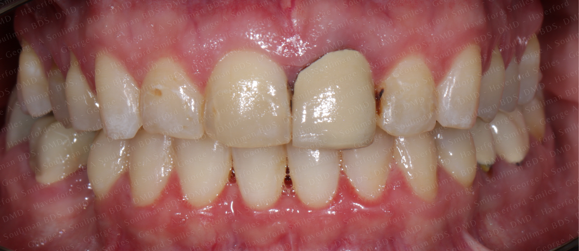 Full mouth rehab Ceramic Veneers, Ceramic Crowns & Ceramic Bridge before
