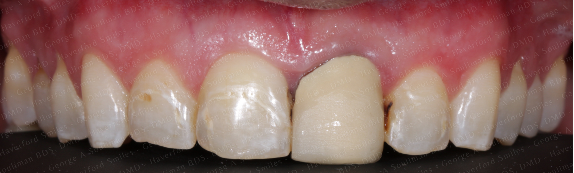 Full mouth rehab Ceramic Veneers, Ceramic Crowns & Ceramic Bridge before