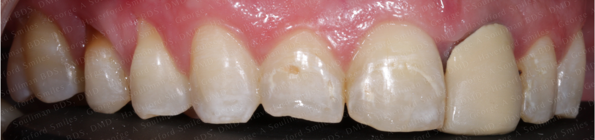 Full mouth rehab Ceramic Veneers, Ceramic Crowns & Ceramic Bridge before