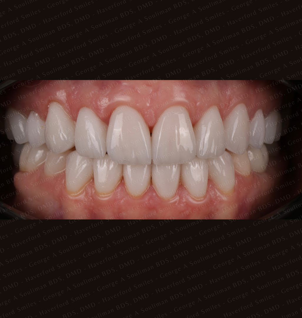 Full mouth rehab Ceramic Veneers, Implants & Ceramic crowns after