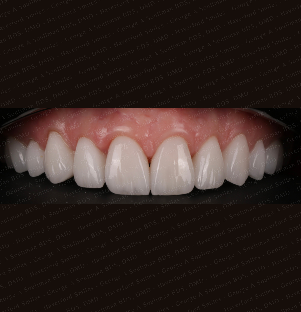 Full mouth rehab Ceramic Veneers, Implants & Ceramic crowns top arch after