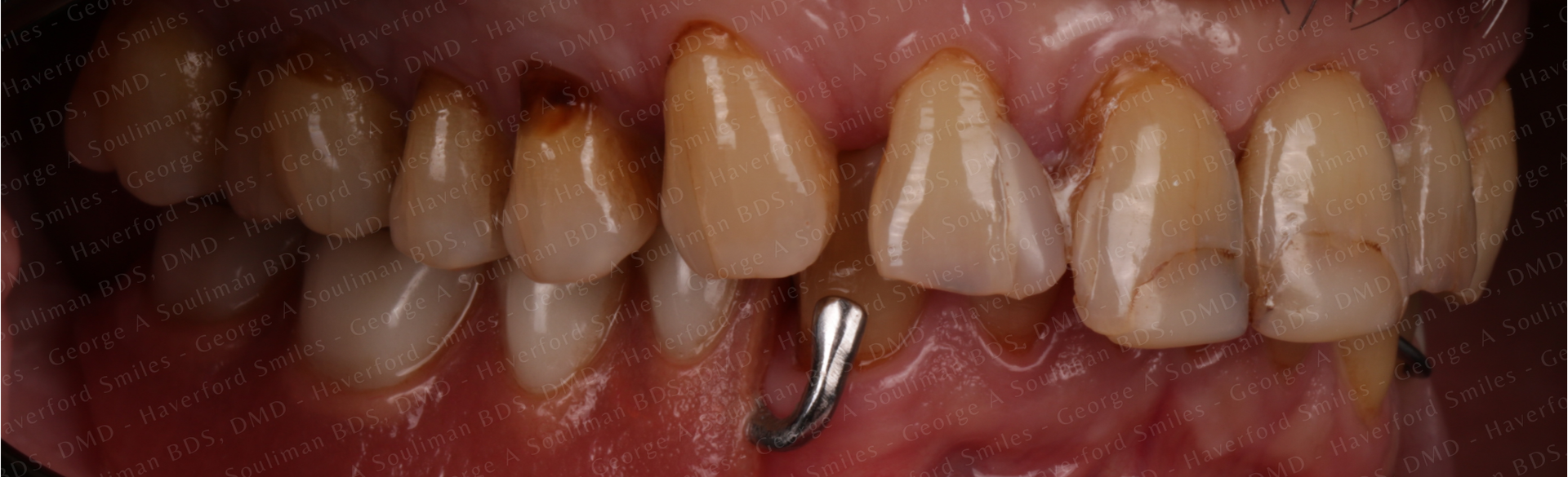 Maxillary arch rehab Upper Ceramic Crowns before