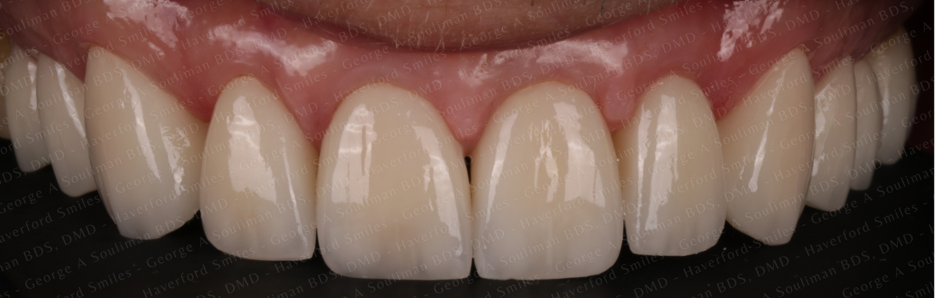 Maxillary arch rehab Upper Ceramic Crowns after