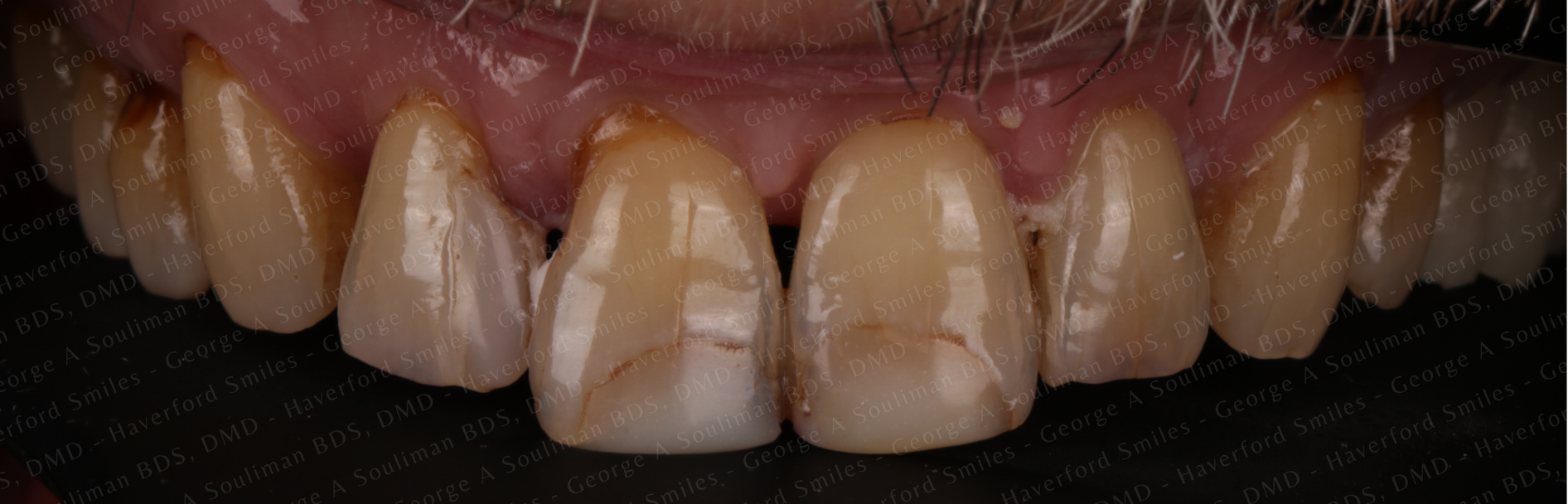 Maxillary arch rehab Upper Ceramic Crowns before
