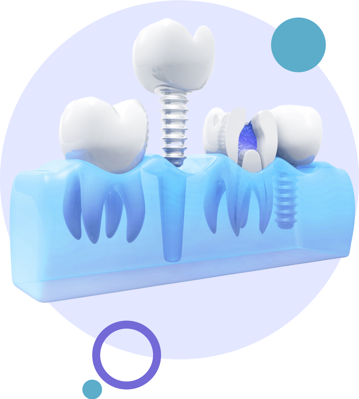 Image of how a dental implant is attached into the jawbone
