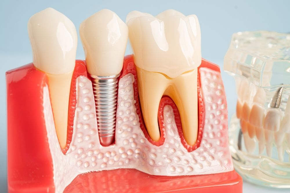 Model of teeth, with one tooth on an implant, showing root and gum structure in red, white, and yellow.