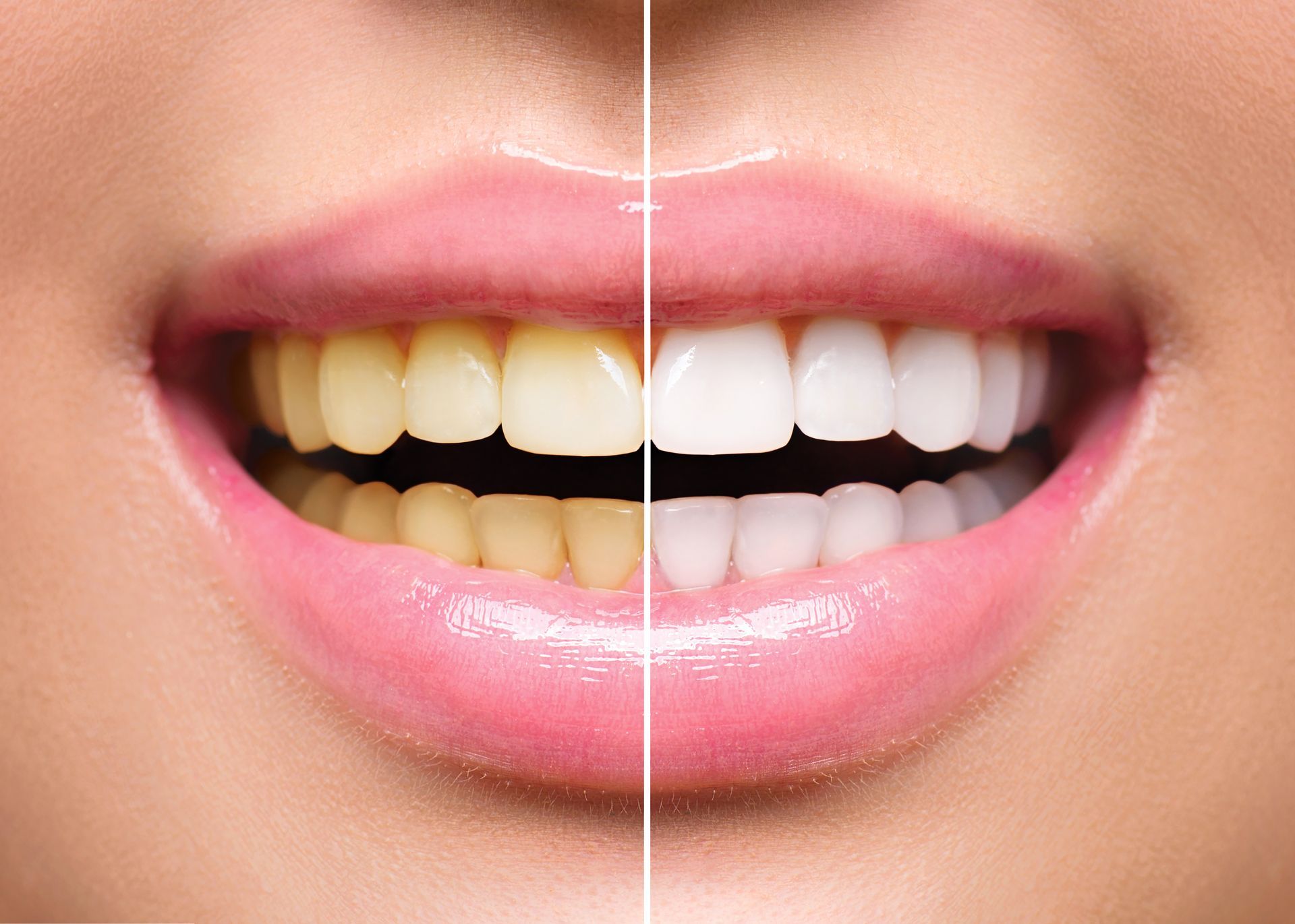A woman 's teeth before and after whitening.