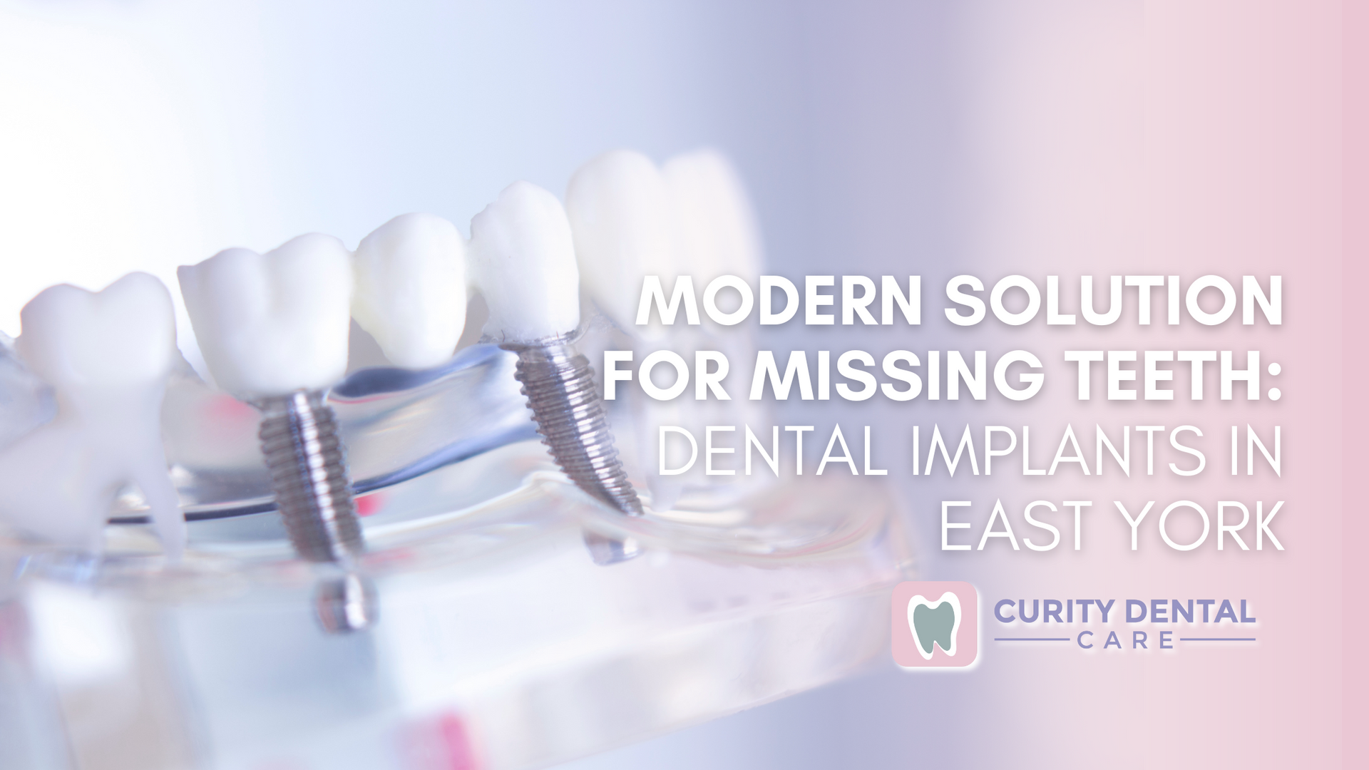 Modern solution for missing teeth : dental implants in east york