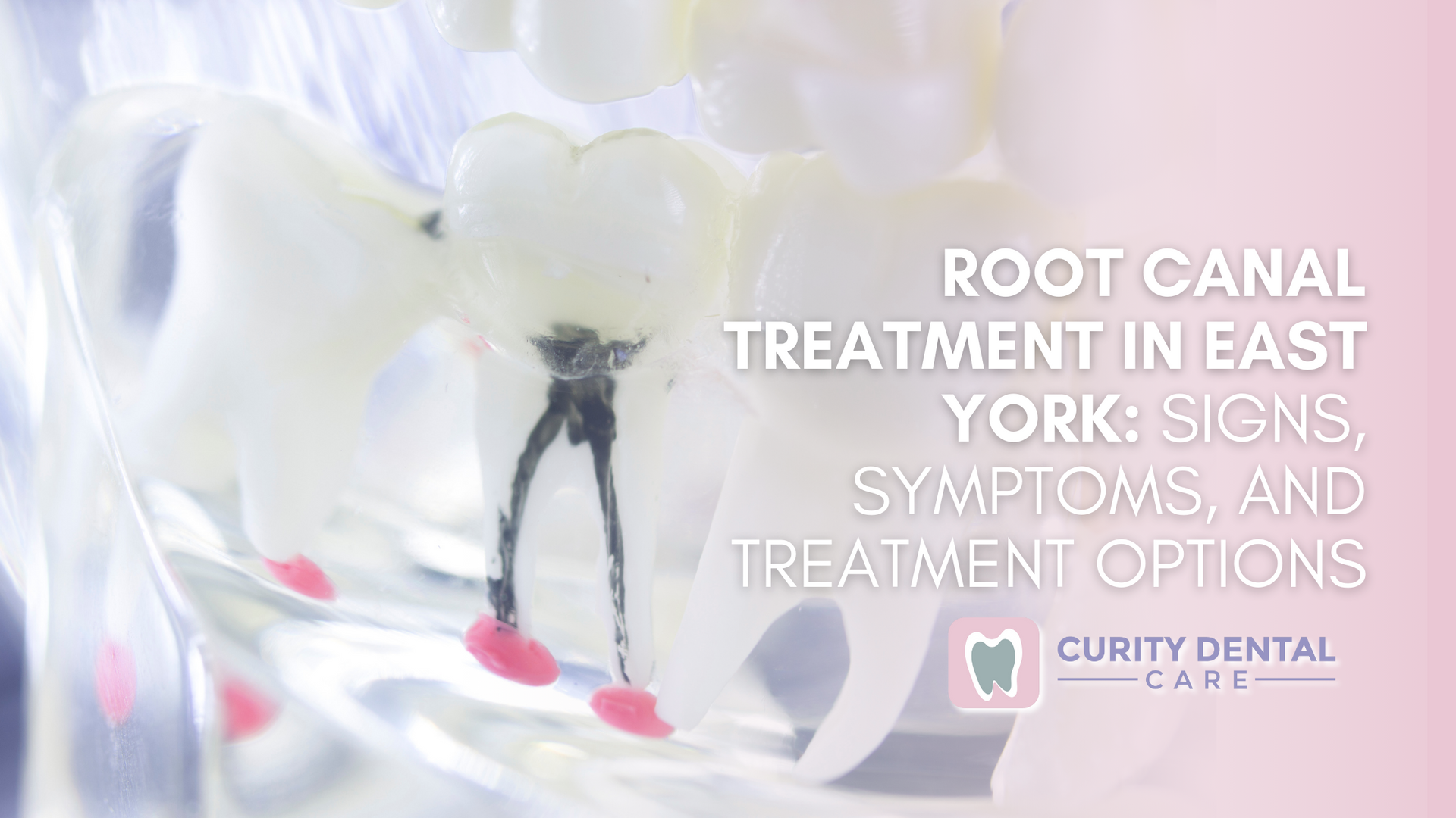 a root canal treatment in east york : signs , symptoms and treatment options