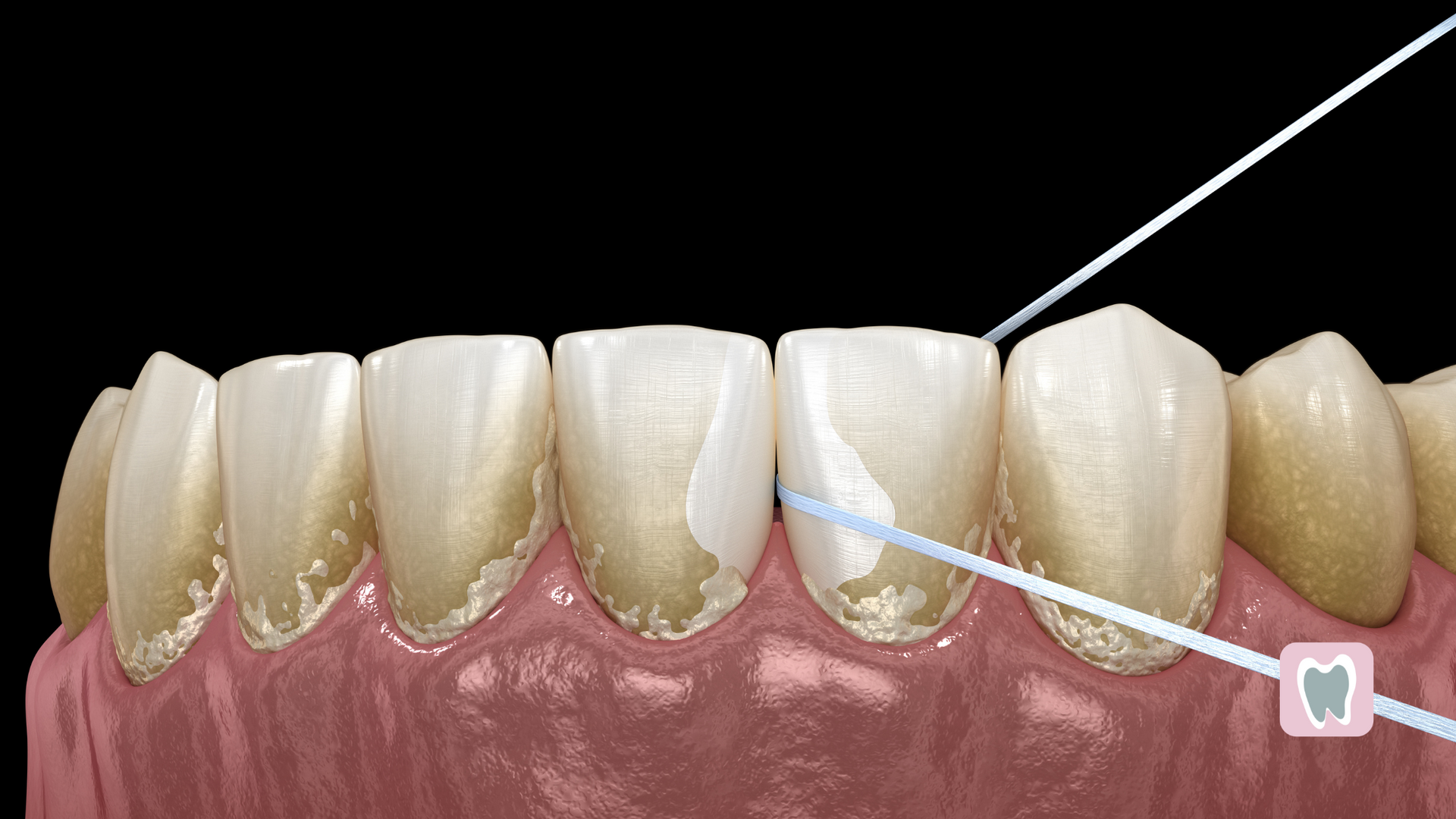 A close up of a person 's teeth with a tooth in the middle.