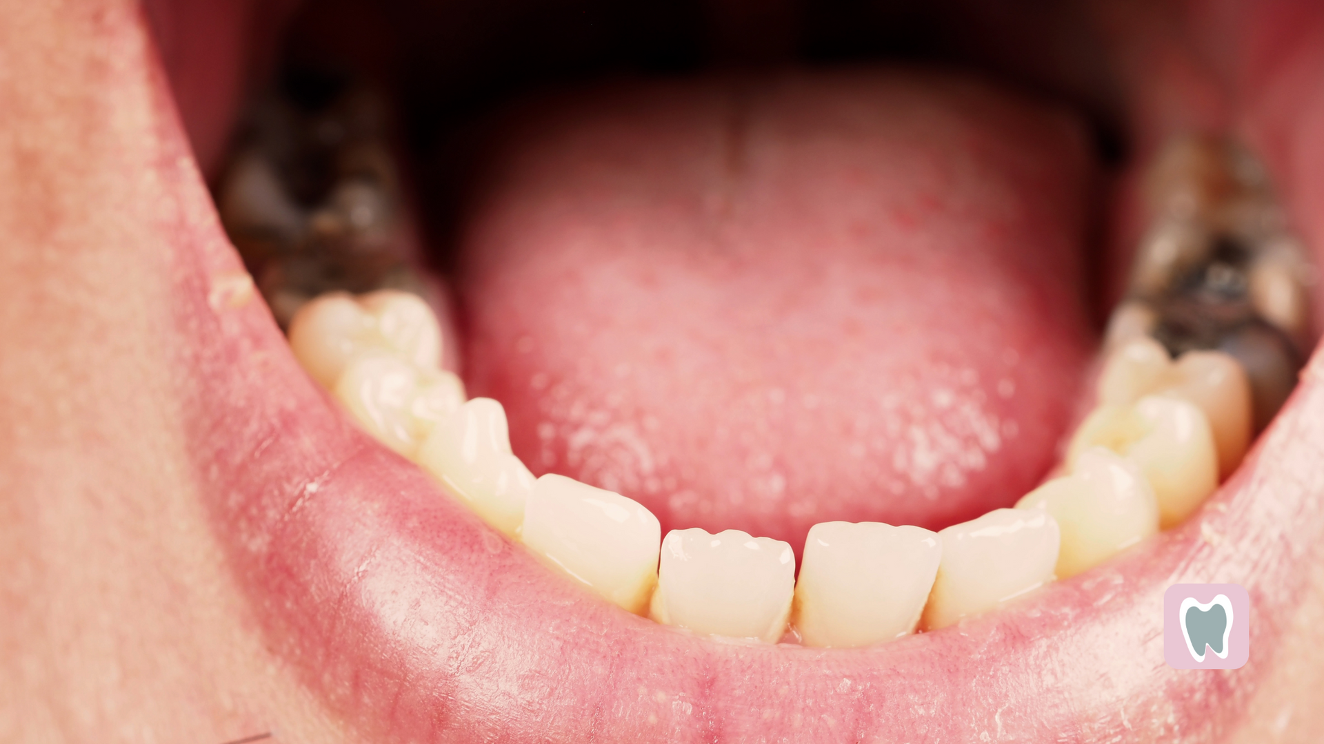 A close up of a person 's mouth with a tooth missing.