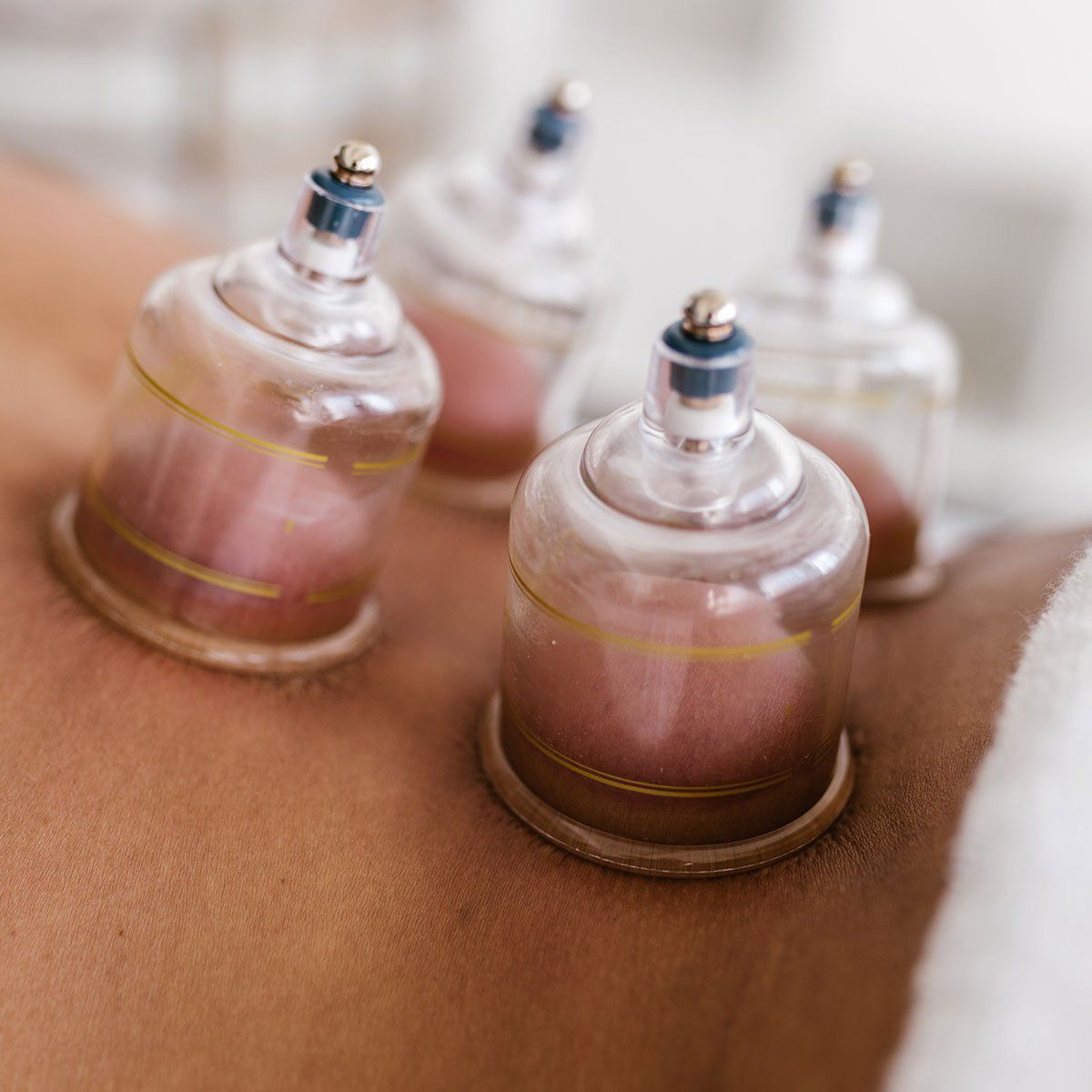 Client receiving a Traditional Chinese medicine Cupping therapy treatment at Health Energies Vaughan Wellness centre