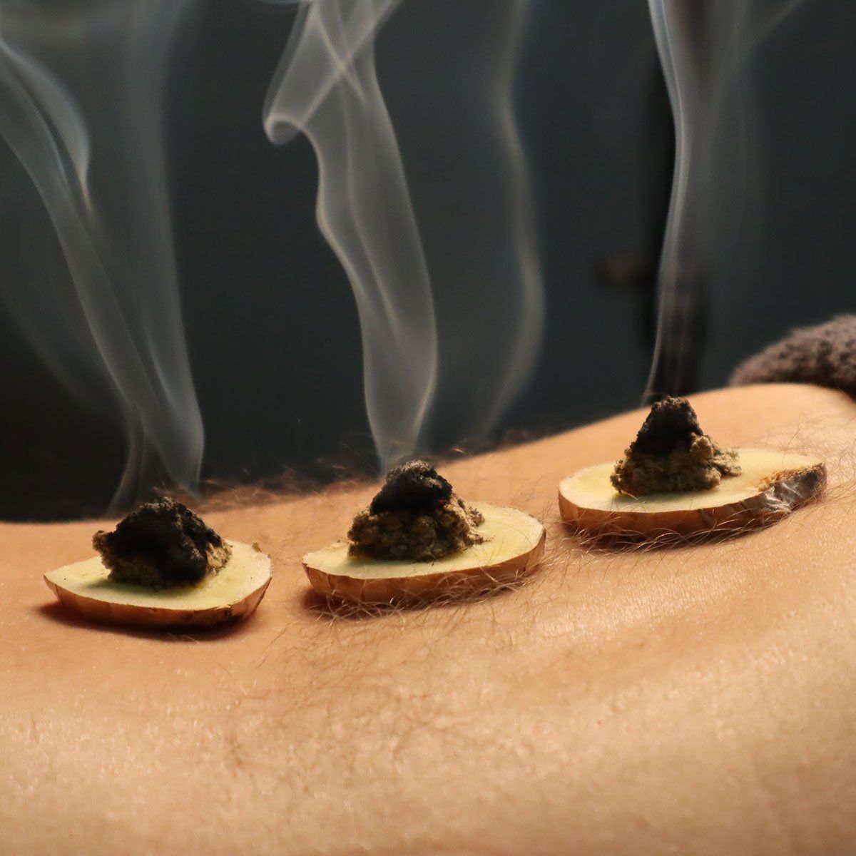 Client receiving a Traditional Chinese medicine Moxibustion treatment at Health Energies Vaughan Wellness centre