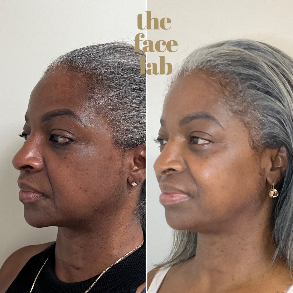 a before and after photo of a woman with the face lab written on the bottom