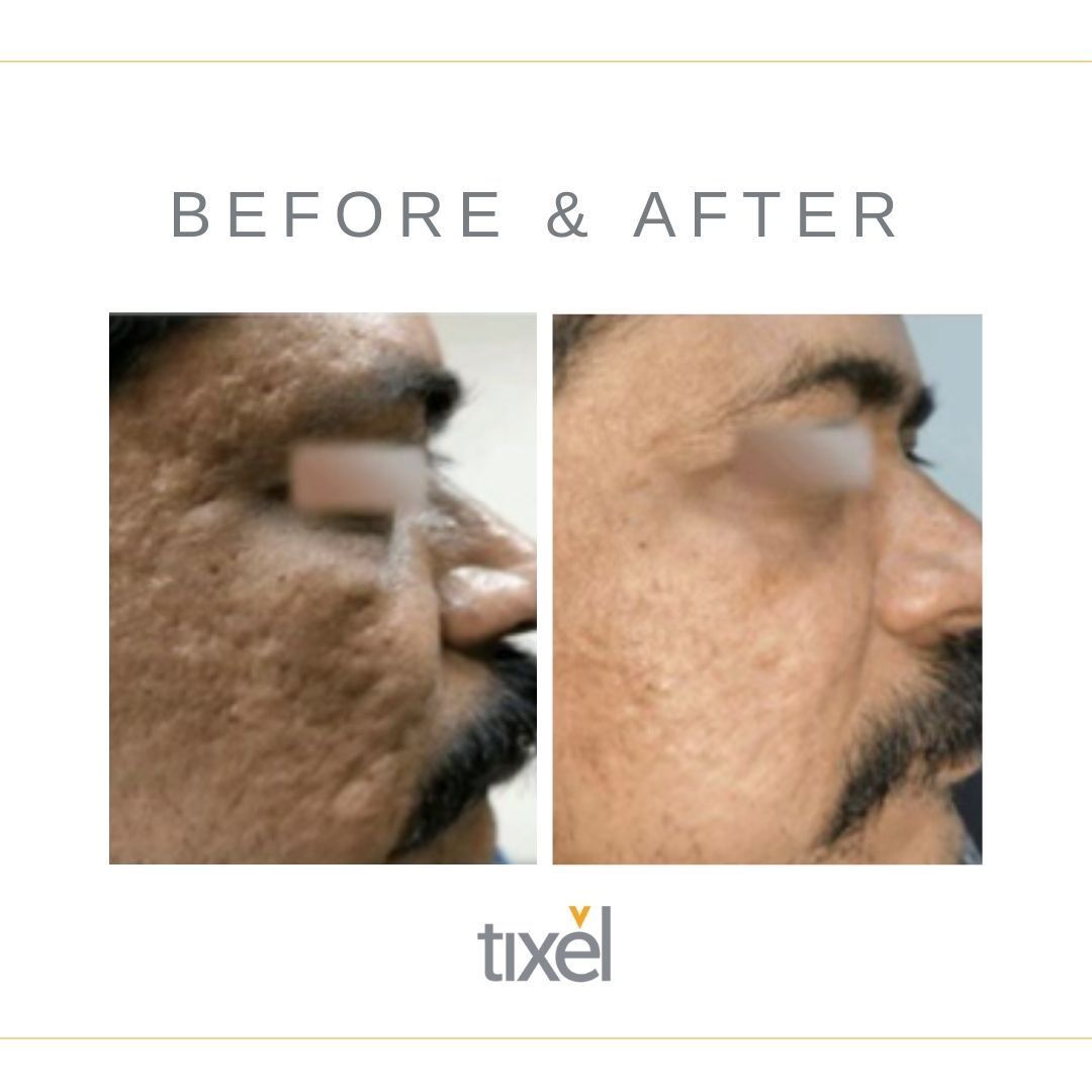 Tixel Skin Resurfacing Before & After image