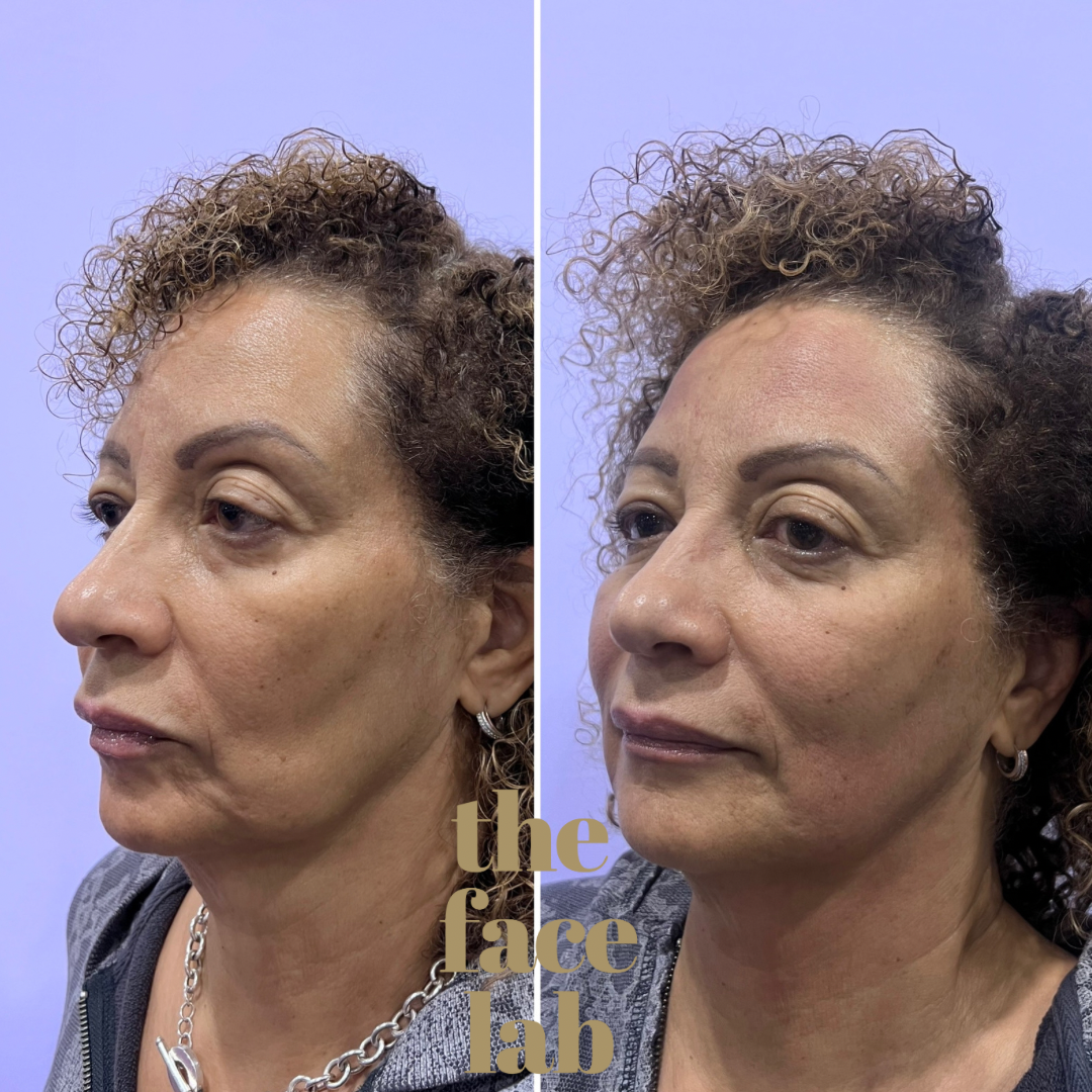 a before and after photo of a woman 's face taken by the face lab