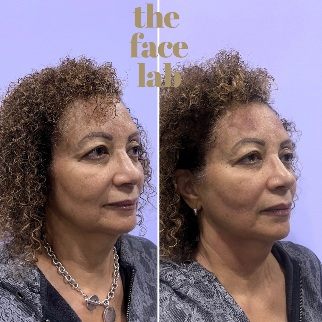 a woman 's face is shown before and after a procedure at the face lab