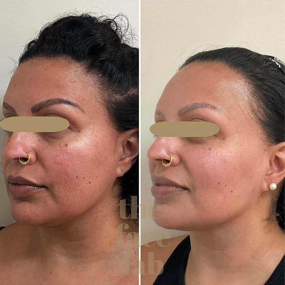 a before and after photo of a woman 's face with the words the face club behind her