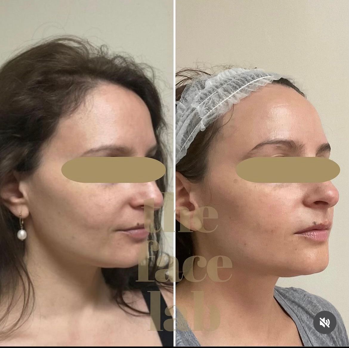 a before and after photo of a woman 's face with the words face lab behind her