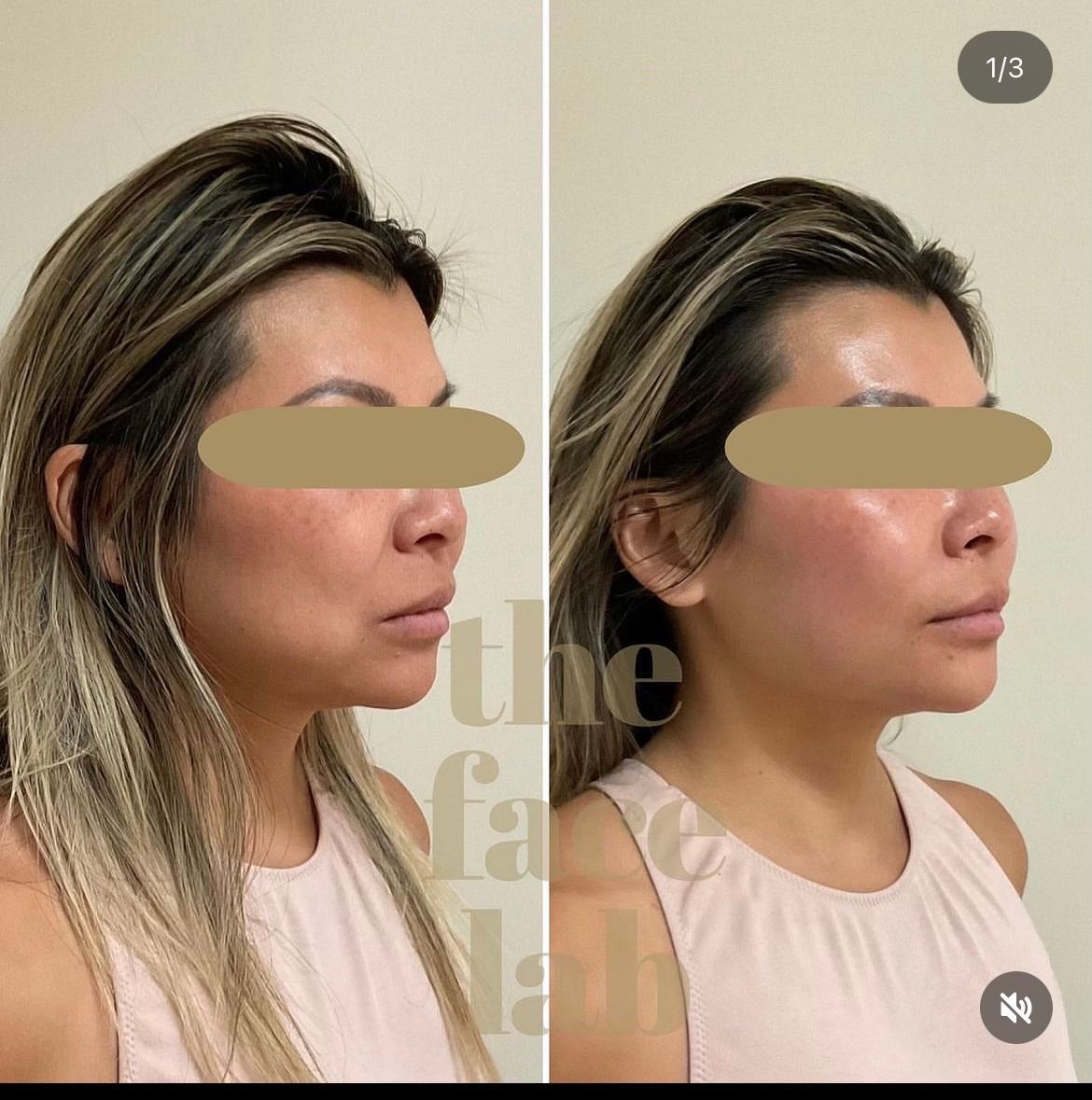 a before and after photo of a woman 's face with the words the face lab behind her