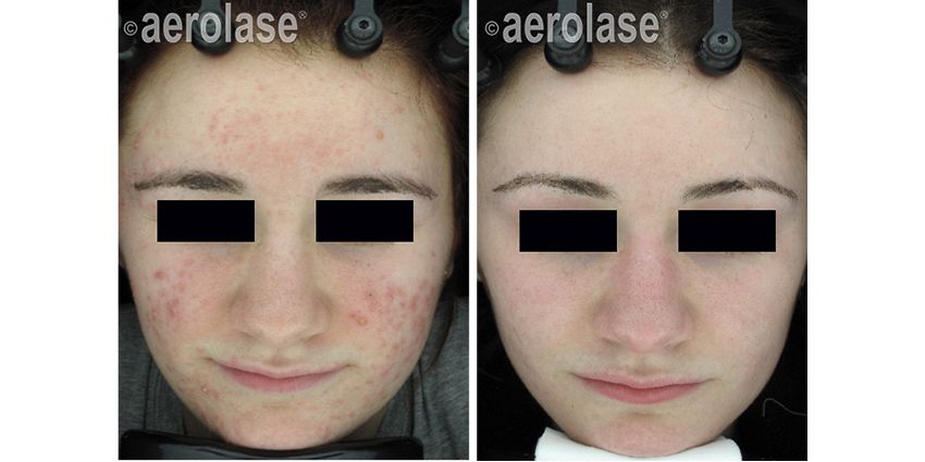 Before & After Aerolase™