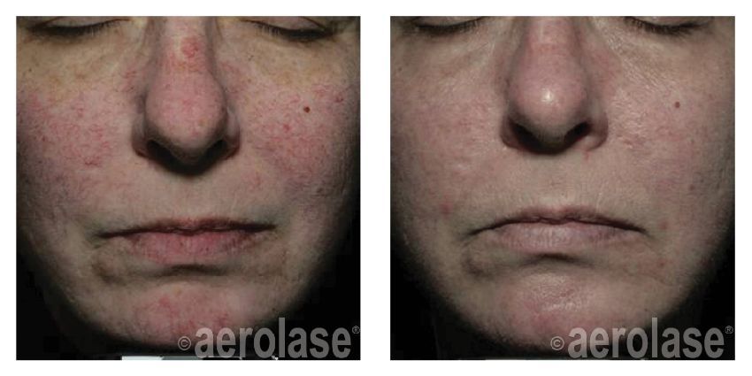Before & After Aerolase™