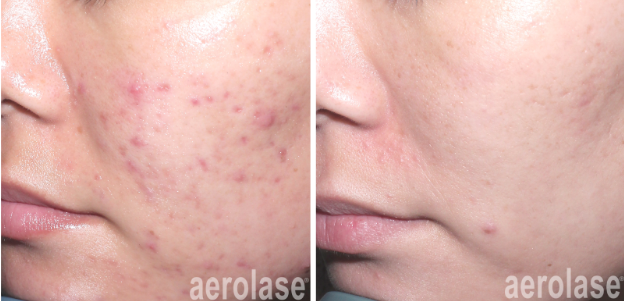 A before and after photo of a woman 's face after using aerolase