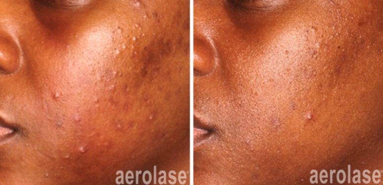 A before and after photo of a person 's face with acne after using Aerolase