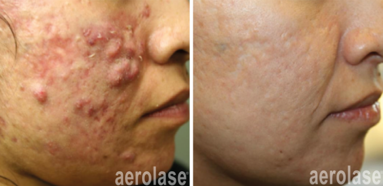 A before and after photo of a woman 's face with acne