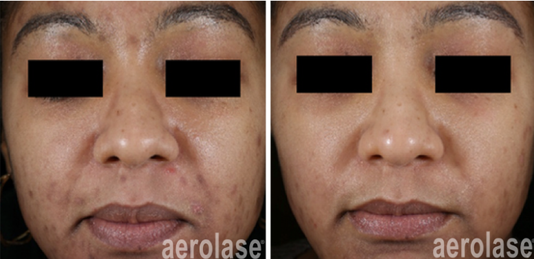 A before and after photo of a person 's face with acne after using Aerolase