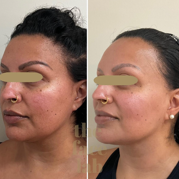 A before and after photo of a woman's face after Sofwave in Toronto