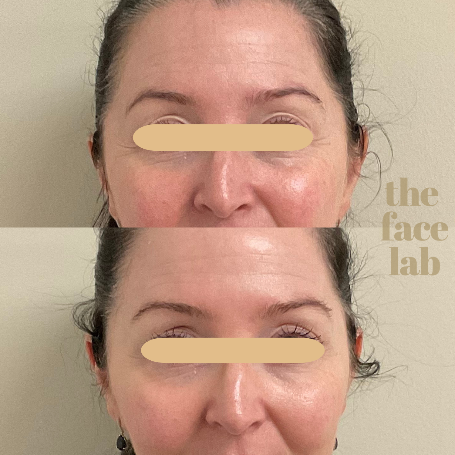 A before and after photo of a woman 's face with eye lift treatment.