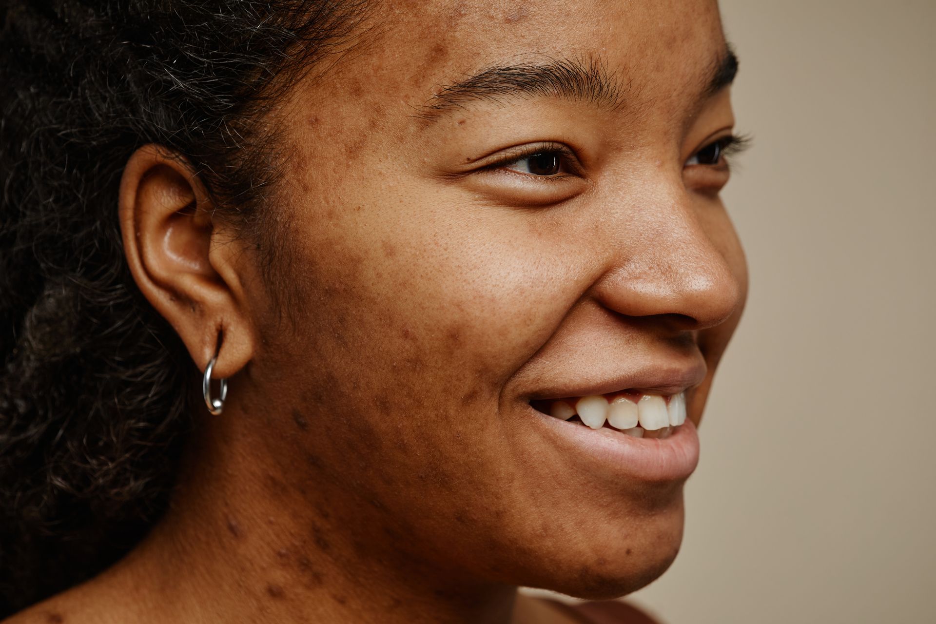 A woman with acne on her face is smiling and wearing hoop earrings.