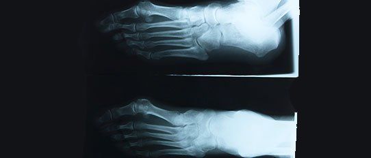 X-ray of ankles and feet - podiatrist in Muscatine, IA