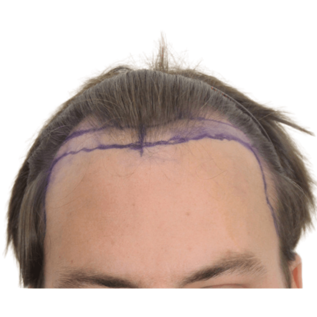 FUE Hair Transplant Sheffield before