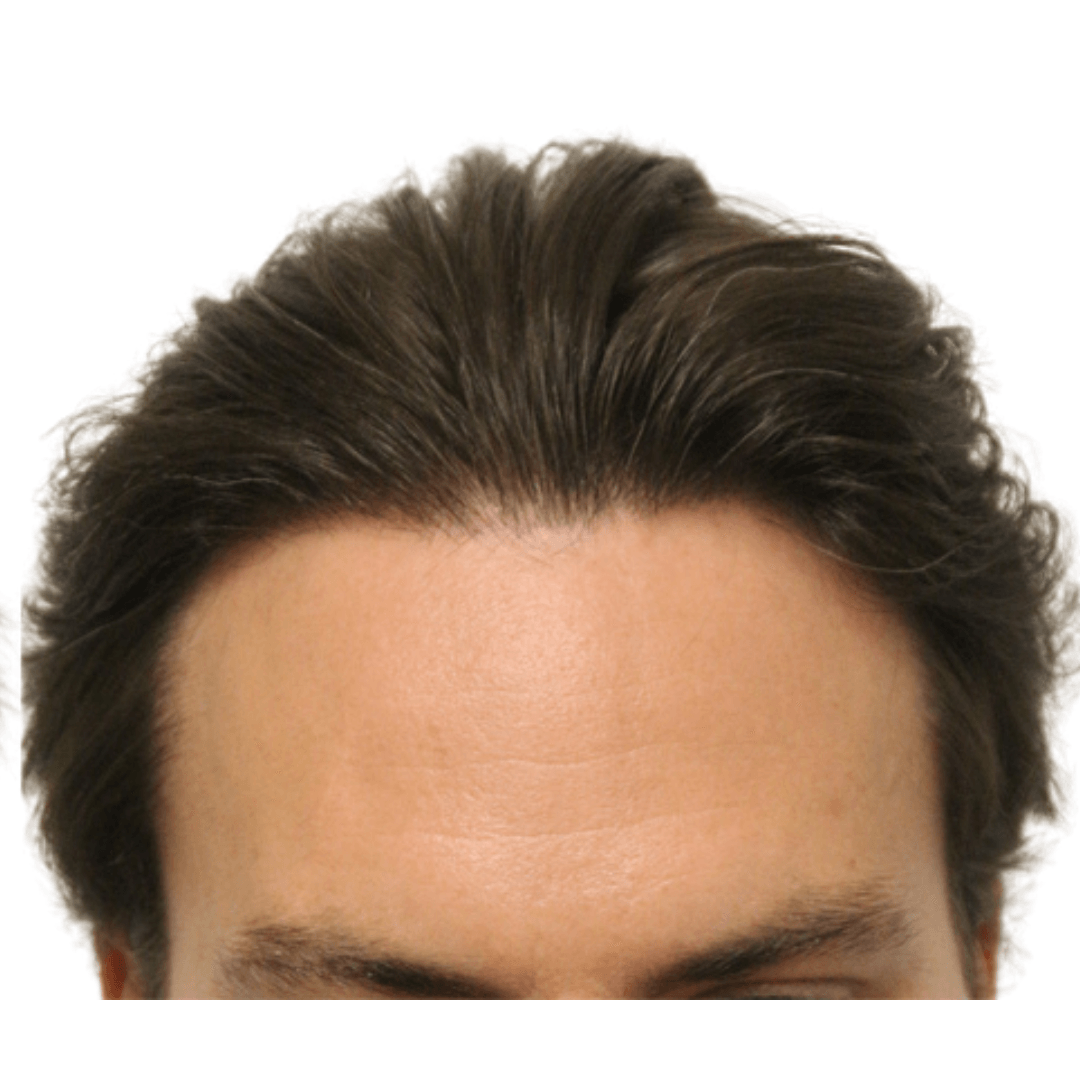 FUE Hair Transplant Sheffield after