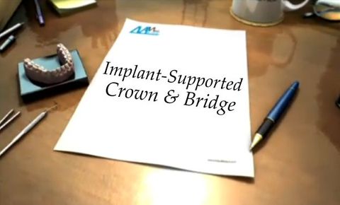 implant_crown_bridge