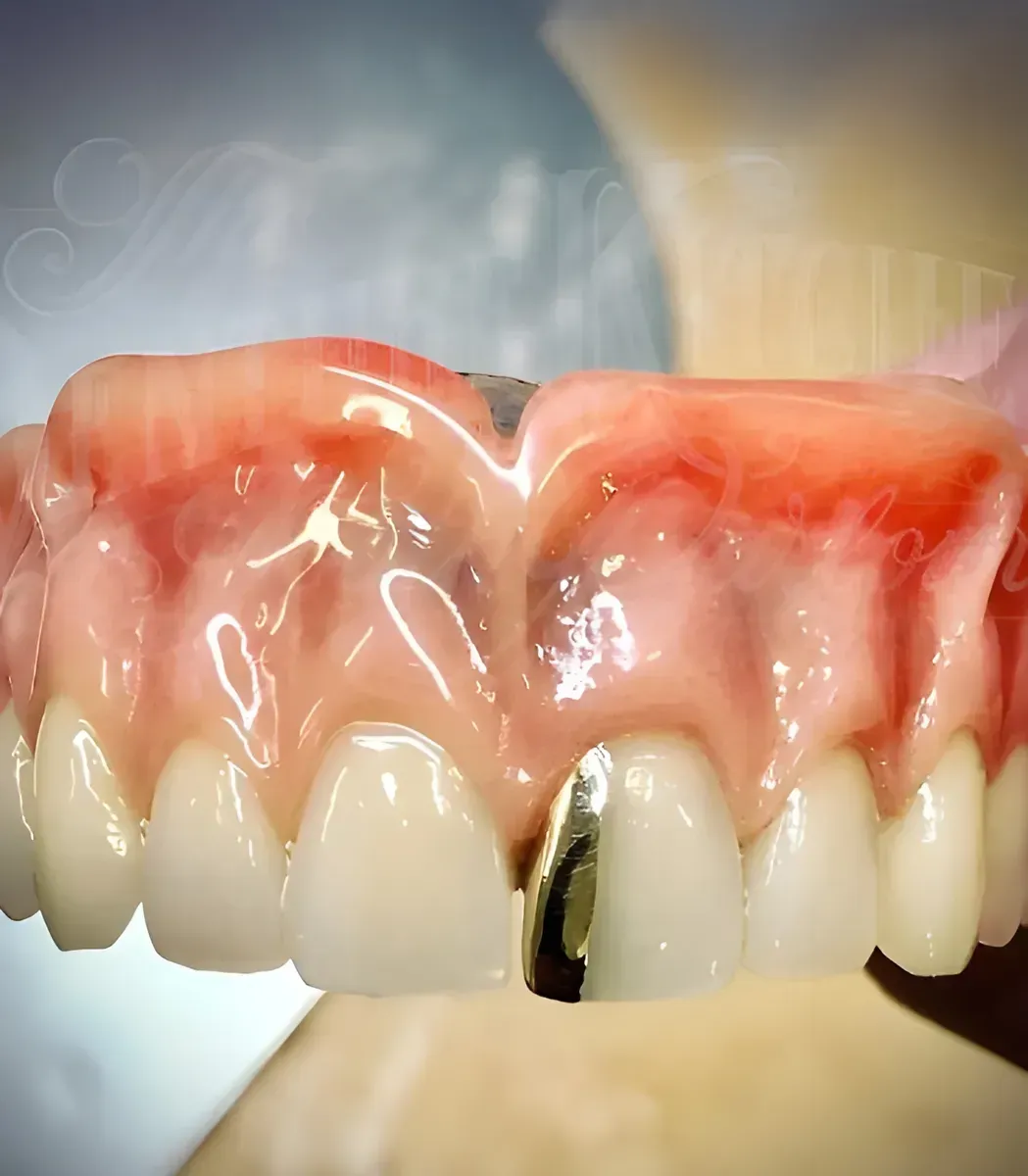 Close-up of Teeth with a Gold Crown